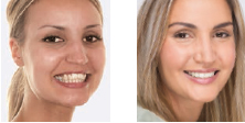 Efekt leczenia Invisalign - uśmiech przed i po